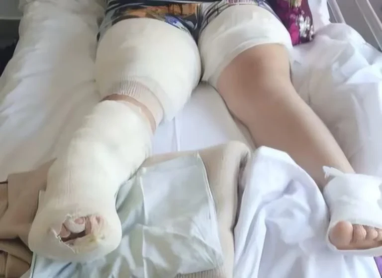 Una niña sufrió graves quemaduras en Comodoro y su familia pide ayuda